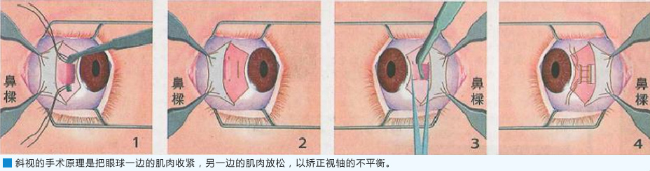 斜视手术的过程