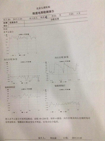 治疗前眼震电图检查结果